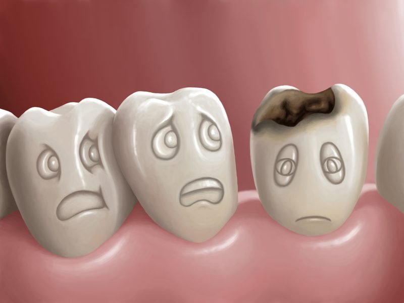 Dental Cavities